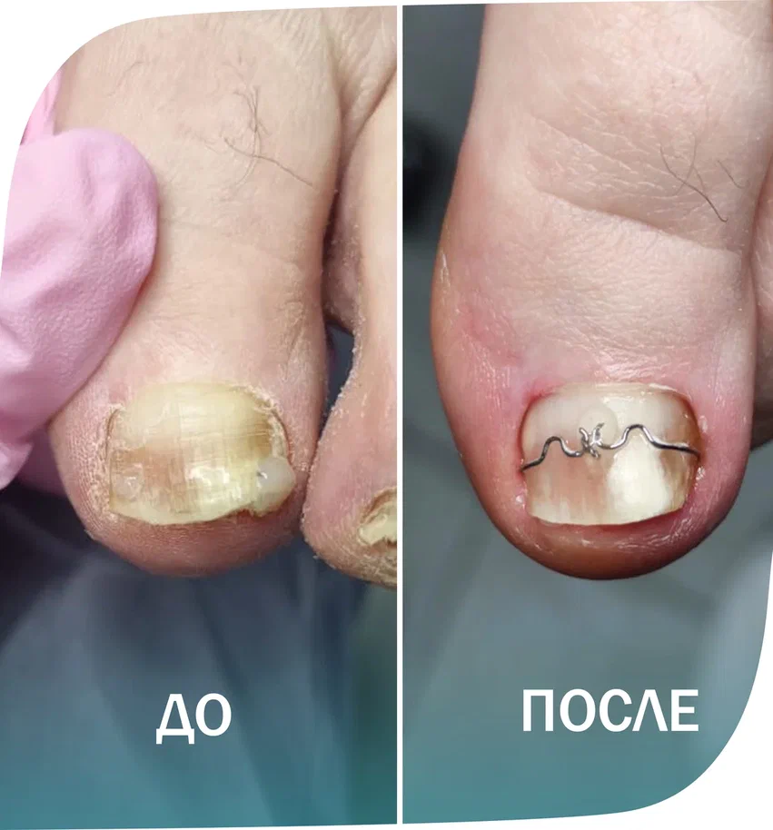 установка