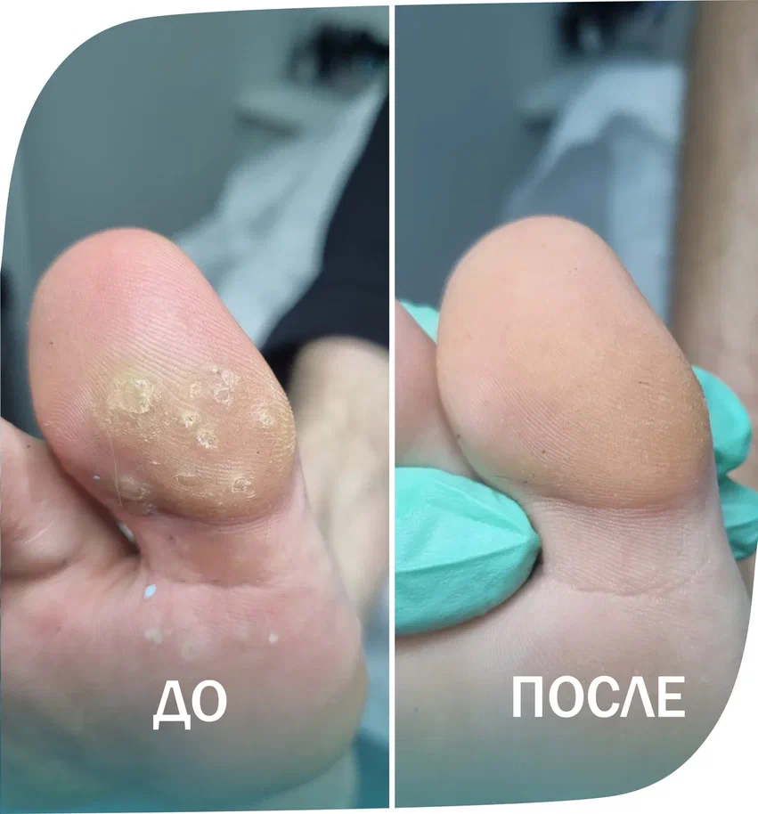 бородавки