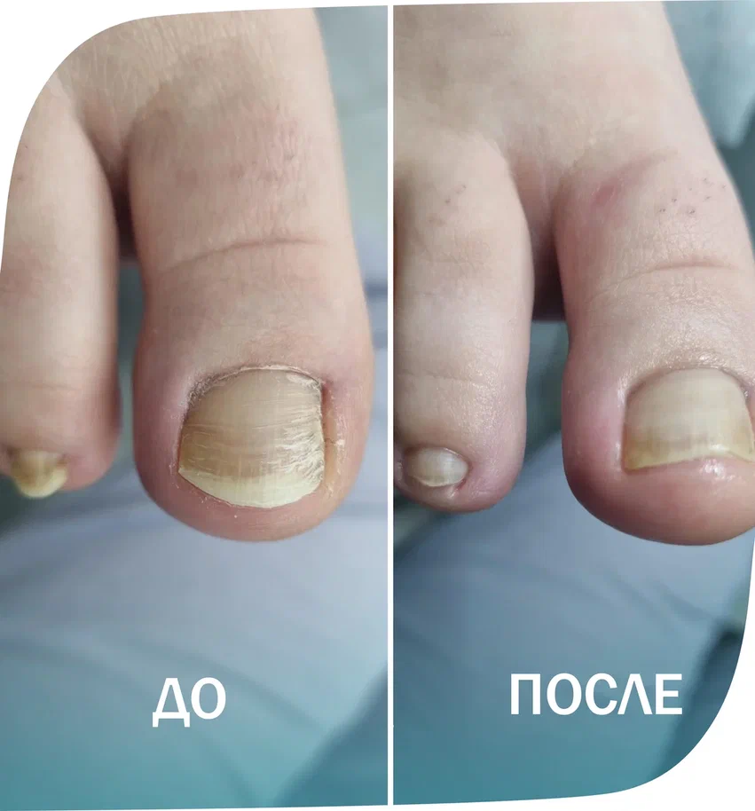 грибок