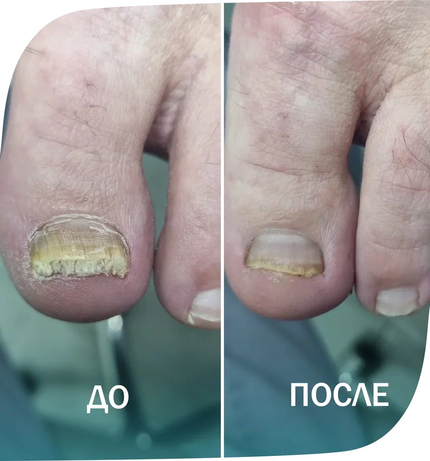 микоз