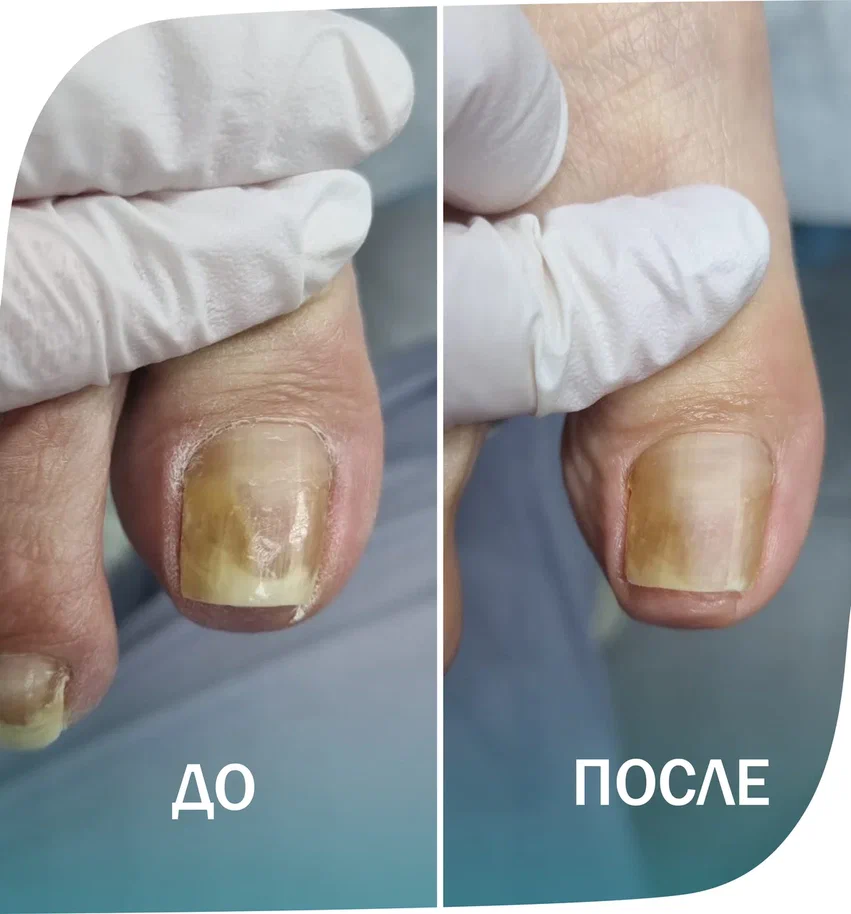 онихолизис