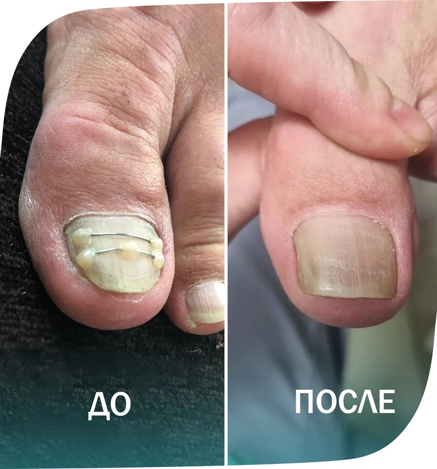 титановая нить