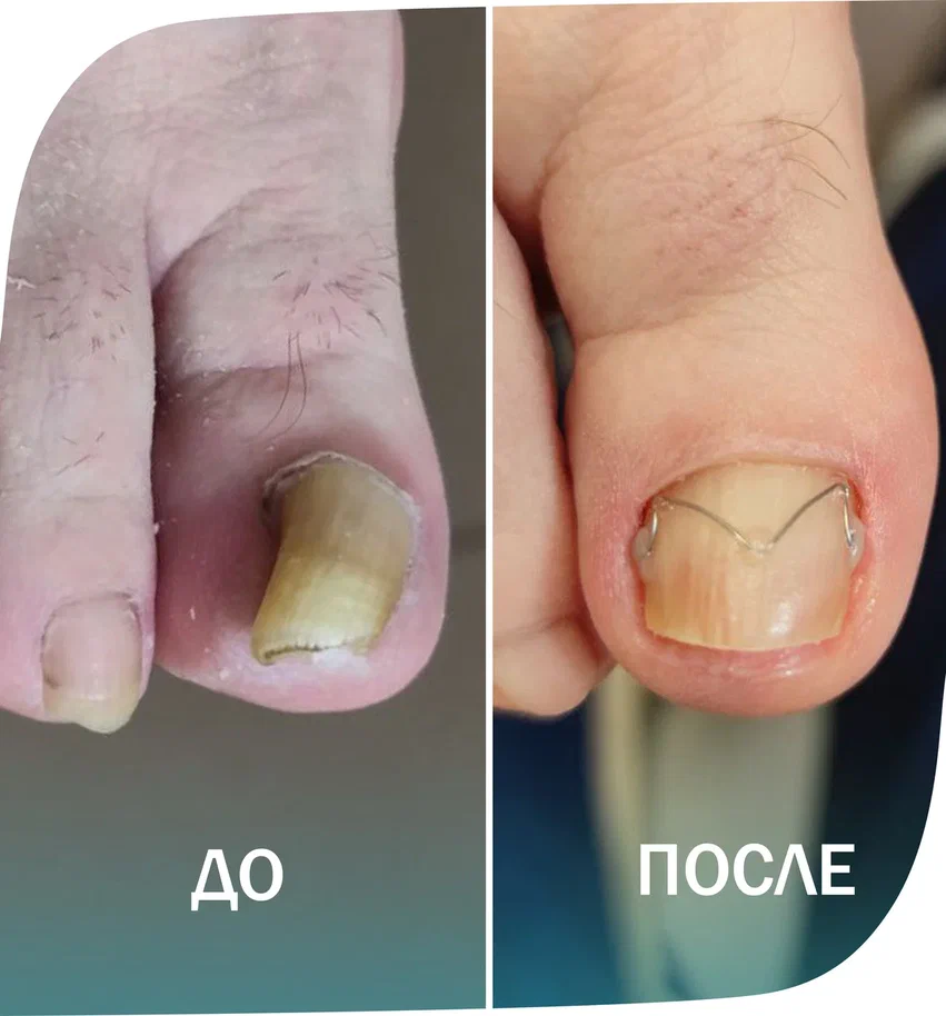 унибрейс