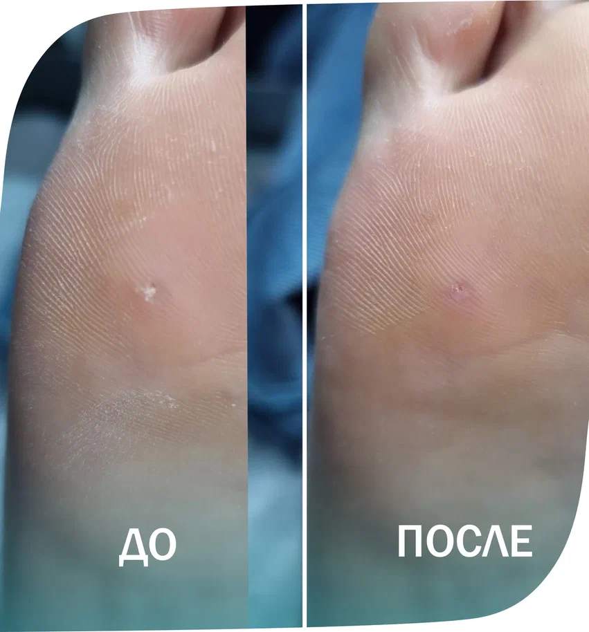 заноза